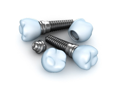 Dental Implant Recovery Process