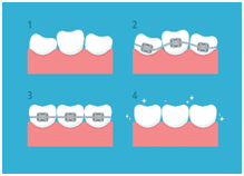 Teeth Straightening