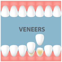 Benefits of Dental Veneers