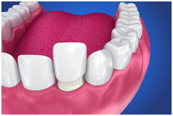 Dental Veneers Are Good for Enamel Loss