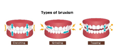 Bruxism