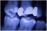 X-ray