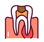 Root canal treatment