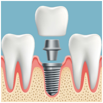 Dental Implants