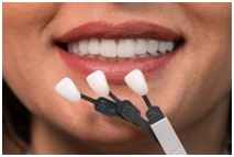 Dental Veneers